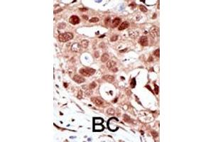 Formalin-fixed and paraffin-embedded human cancer tissue reacted with the primary antibody, which was peroxidase-conjugated to the secondary antibody, followed by AEC staining.
