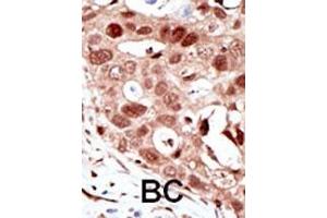 Formalin-fixed and paraffin-embedded human cancer tissue reacted with the primary antibody, which was peroxidase-conjugated to the secondary antibody, followed by AEC staining. (SUMO2 anticorps  (C-Term))