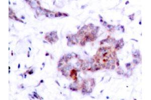 Immunohistochemical analysis of paraffin-embedded human breast cancer tissue using REL polyclonal antibody . (c-Rel anticorps)