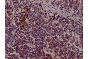 IHC image of ABIN7127588 diluted at 1:100 and staining in paraffin-embedded human lung cancer performed on a Leica BondTM system. (Recombinant JAK3 anticorps)