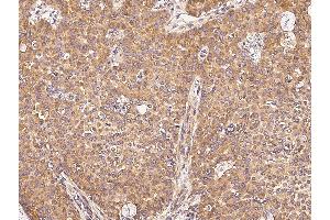 Immunochemical staining of human UBE4A in human breast carcinoma with rabbit polyclonal antibody (0. (Cobaye anti-Lapin IgG (Heavy & Light Chain) Anticorps (Alkaline Phosphatase (AP)) - Preadsorbed)