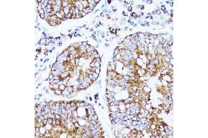 Immunohistochemistry of paraffin-embedded human colon carcinoma using CYCS antibody. (Cytochrome C anticorps  (AA 1-105))