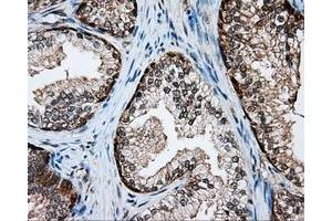 Immunohistochemical staining of paraffin-embedded Adenocarcinoma of colon tissue using anti-SRR mouse monoclonal antibody. (SRR anticorps)