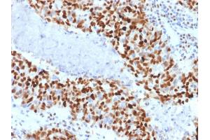 Formalin-fixed, paraffin-embedded human Colon Carcinoma stained with Cyclin E Mouse Monoclonal Antibody (CCNE1/2460).