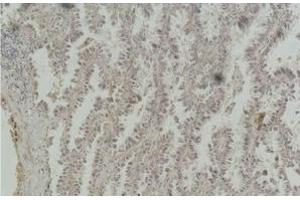 Immunohistochemistry of paraffin-embedded Human lung carcinoma tissue with CREB1 Monoclonal Antibody