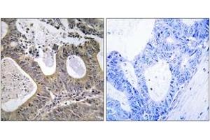 Immunohistochemistry analysis of paraffin-embedded human colon carcinoma tissue, using STEA2 Antibody. (STEAP2 anticorps  (AA 431-480))