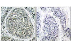Immunohistochemical analysis of paraffin-embedded human breast carcinoma tissue, using β-Catenin (phospho-Ser37) antibody (E011219). (beta Catenin anticorps  (pSer37))