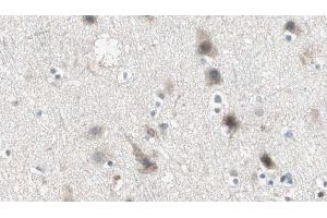 ABIN6274945 at 1/100 staining Human brain cancer tissue by IHC-P. (ABCC3 anticorps  (Internal Region))