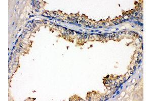 Anti- BMPR1B Picoband antibody,IHC(P) IHC(P): Human Prostatic Cancer Tissue (BMPR1B anticorps  (AA 14-184))