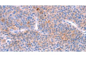 Immunohistochemistry of paraffin-embedded Human liver cancer using AADAC Polyclonal Antibody at dilution of 1:30