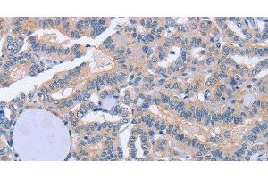 Immunohistochemistry of paraffin-embedded Human thyroid cancer tissue using BOD1 Polyclonal Antibody at dilution 1:60 (BOD1 anticorps)