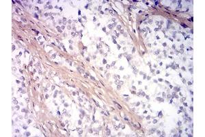 Immunohistochemical analysis of paraffin-embedded bladder cancer tissues using PINK1 mouse mAb with DAB staining.