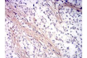 Immunohistochemical analysis of paraffin-embedded bladder cancer tissues using PINK1 mouse mAb with DAB staining. (PINK1 anticorps  (AA 112-273))