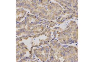 Immunohistochemistry of paraffin-embedded human thyroid cancer using XRCC2 antibody. (XRCC2 anticorps)