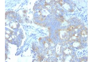 Formalin-fixed, paraffin-embedded human Colon Carcinoma stained with Heparan Sulfate Monoclonal Antibody (A7L6). (HSPG2 anticorps)