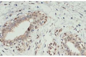 Immunohistochemistry of paraffin-embedded Human breast cancer using KDM6A Polyclonal Antibody at dilution of 1:200 (40x lens). (KDM6A anticorps)