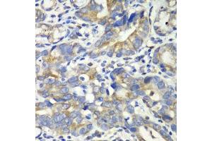 Immunohistochemistry of paraffin-embedded human gastric cancer using ABAT antibody.