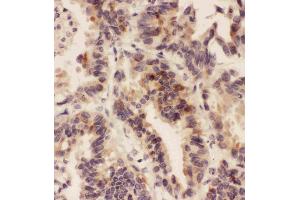 Anti-HSD11B1  antibody, IHC(P)IHC(P): Human Lung Cancer Tissue (HSD11B1 anticorps  (N-Term))