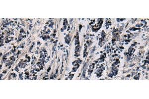Immunohistochemistry of paraffin-embedded Human breast cancer tissue using SNIP1 Polyclonal Antibody at dilution of 1:80(x200)