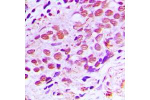 Immunohistochemical analysis of XPA staining in human breast cancer formalin fixed paraffin embedded tissue section. (XPA anticorps  (C-Term))