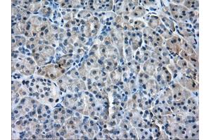 Immunohistochemical staining of paraffin-embedded Adenocarcinoma of Human ovary tissue using anti-PDE4A mouse monoclonal antibody. (PDE4A anticorps)