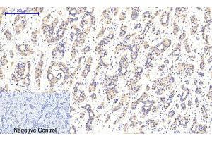 Immunohistochemical analysis of paraffin-embedded human liver cancer tissue. (CaMKIIbeta/gamma/delta anticorps  (pThr287))