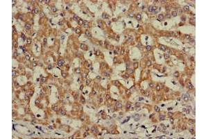 Immunohistochemistry of paraffin-embedded human liver cancer using ABIN7156331 at dilution of 1:100