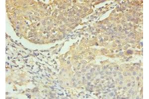 IHC analysis of paraffin-embedded human colon cancer, using Caspase 3 antibody (1/100 dilution).