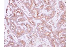 IHC-P Image Immunohistochemical analysis of paraffin-embedded human breast cancer, using NELL1, antibody at 1:250 dilution. (NELL1 anticorps  (Center))