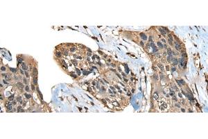 Immunohistochemistry of paraffin-embedded Human esophagus cancer tissue using ATXN3 Polyclonal Antibody at dilution of 1:100(x200) (Ataxin 3 anticorps)