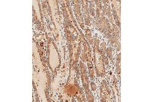 Immunohistochemical analysis of paraffin-embedded Human thyroid carcinoma tissue using (ABIN651869 and ABIN2840430) performed on the Leica® BOND RXm.