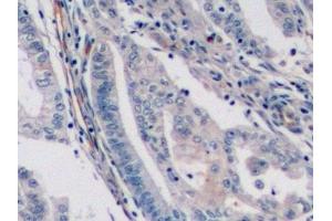 Detection of ENG in Human Endometrial cancer Tissue using Monoclonal Antibody to Endoglin (ENG)