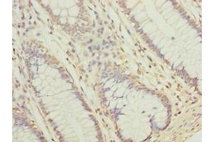 Immunohistochemistry of paraffin-embedded human colon cancer using ABIN7157067 at dilution of 1:100 (NUBPL anticorps  (AA 39-319))