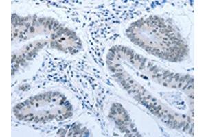 The image on the left is immunohistochemistry of paraffin-embedded Human colon cancer tissue using ABIN7189621(ACIN1 Antibody) at dilution 1/30, on the right is treated with synthetic peptide. (ACIN1 anticorps)