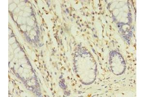 Immunohistochemistry of paraffin-embedded human colon cancer using ABIN7173349 at dilution of 1:100 (TREML2 anticorps  (AA 19-268))