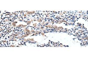Immunohistochemistry of paraffin-embedded Human cervical cancer tissue using ELMO1 Polyclonal Antibody at dilution of 1:40(x200) (ELMO1 anticorps)