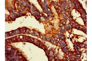 Immunohistochemistry of paraffin-embedded human endometrial cancer using ABIN7163724 at dilution of 1:100