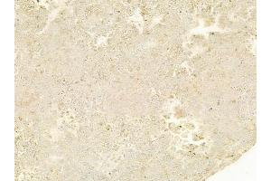 ABIN6263603 and ABIN6278495 at 1/100 staining human melanoma by IHC-P. (Netrin 1 anticorps  (C-Term))