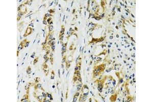 Immunohistochemistry of paraffin-embedded Human colon carcinoma using TNNC1 Polyclonal Antibody at dilution of 1:100 (40x lens). (TNNC1 anticorps)