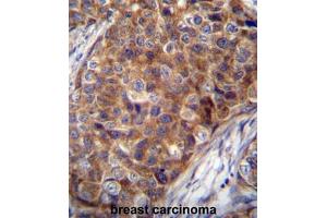 COX7A2L Antibody (Center) immunohistochemistry analysis in formalin fixed and paraffin embedded human breast carcinoma followed by peroxidase conjugation of the secondary antibody and DAB staining. (COX7A2L anticorps  (Middle Region))