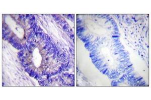 Immunohistochemical analysis of paraffin-embedded human colon carcinoma tissue using PKA α/β CAT (Phospho-Thr197) antibody (left)or the same antibody preincubated with blocking peptide (right).
