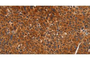 Immunohistochemistry of paraffin-embedded Human liver cancer using CDK19 Polyclonal Antibody at dilution of 1:70 (CDK19 anticorps)