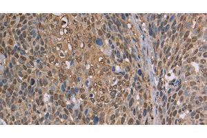 Immunohistochemistry of paraffin-embedded Human cervical cancer using CAB39 Polyclonal Antibody at dilution of 1:50 (CAB39 anticorps)