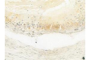 ABIN6264005 and ABIN6279673 at 1/100 staining human testicular cancer by IHC-P. (PABPC3 anticorps  (Internal Region))