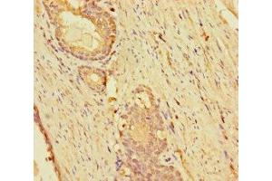 Immunohistochemistry of paraffin-embedded human prostate cancer using ABIN7157298 at dilution of 1:100 (KLHL38 anticorps  (AA 1-200))