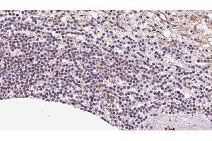 ABIN6273085 at 1/100 staining Human lymph cancer tissue by IHC-P. (VNN1 anticorps)