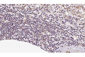 ABIN6273085 at 1/100 staining Human lymph cancer tissue by IHC-P.