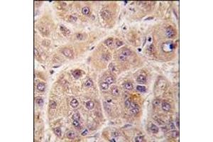 Formalin-fixed and paraffin-embedded human hepatocarcinoma tissue reacted with PIM3 antibody (C-term), which was peroxidase-conjugated to the secondary antibody, followed by DAB staining. (PIM3 anticorps  (C-Term))