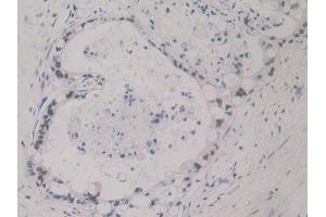 IHC-P analysis of Human Bile duct cancer Tissue, with DAB staining.
