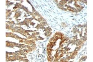 Formalin-fixed, paraffin-embedded human ovarian carcinoma stained with VEGF antibody (VEGF/1063). (VEGFA anticorps)